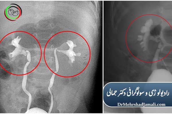 VCUG برای چیست؟ مهم‌ترین کاربردها