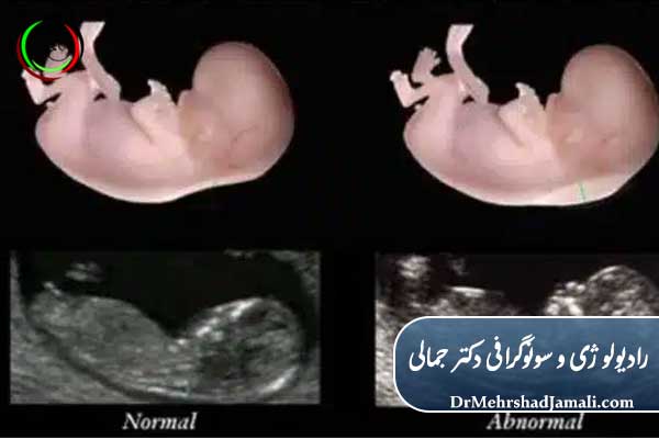نتایج و تفسیر سونوگرافی NT
