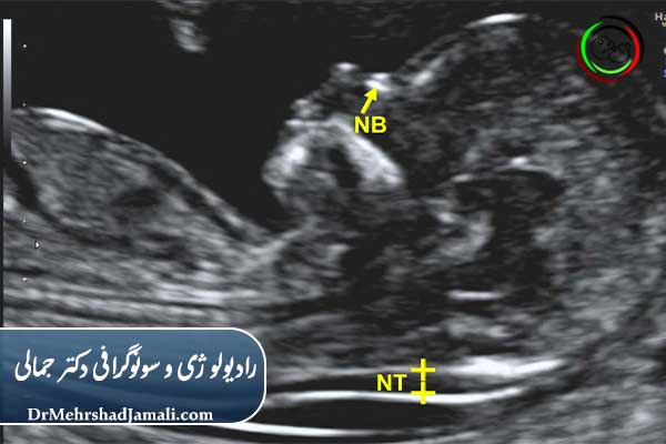 تفاوت NB با NT (ضخامت پشت گردن جنین)