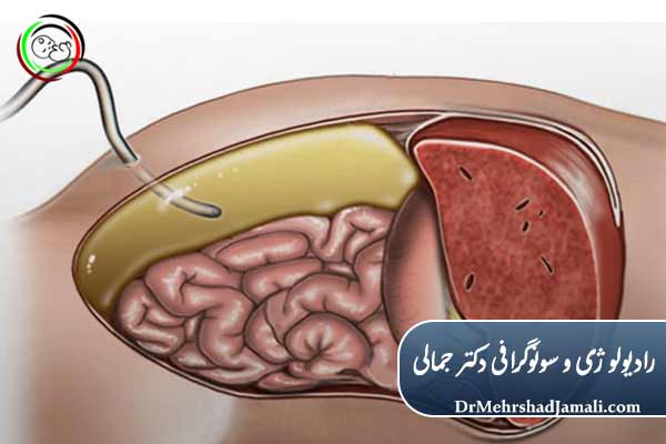 سونوگرافی بهترین روش برای تخلیه مایع شکمی