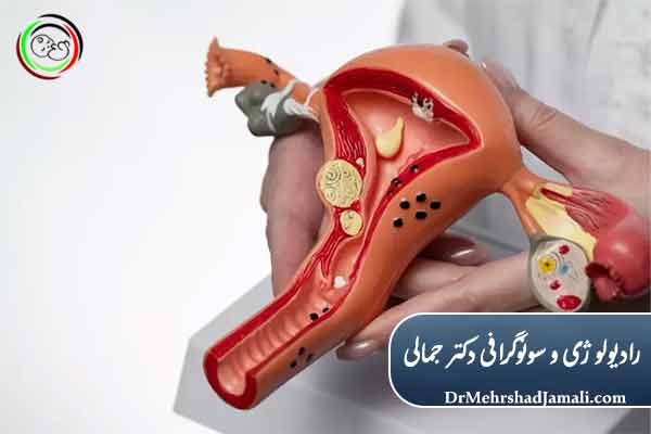 مزایای تخلیه و الیشن اندومتریوز