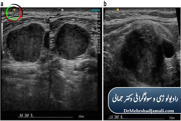 غدد لنفاوی گردن