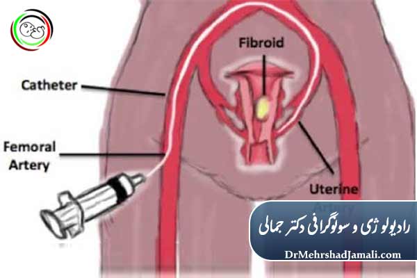 امبولیزاسیون فیبروم، آدنومیوز و بقایای بارداری