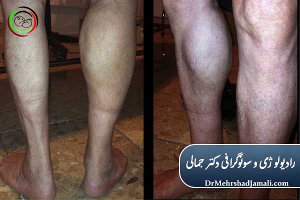 علائم بیکر سیست