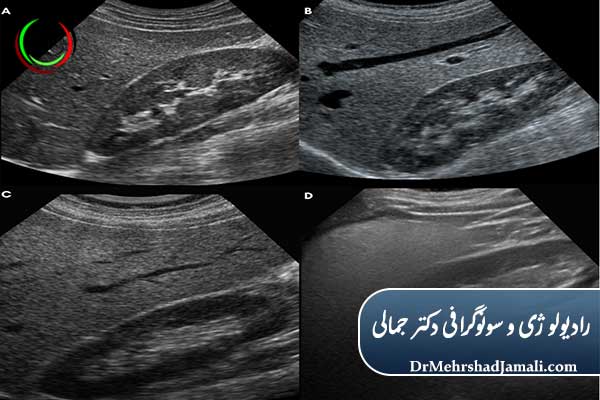 تشخیص کبد چرب چگونه انجام می‌شود؟