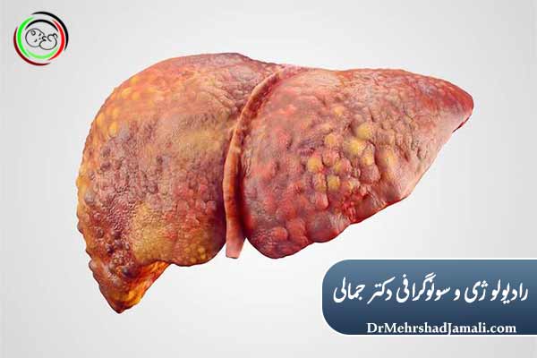چه کسانی بیشتر در معرض سیروز کبدی هستند؟