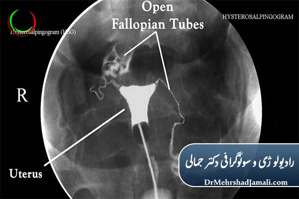 عکس رنگی رحم (HSG)