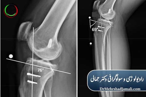 رادیوگرافی زانو