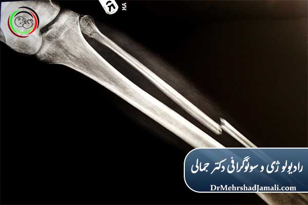 نقش رادیولوژی در تعیین نوع درمان شکستگی