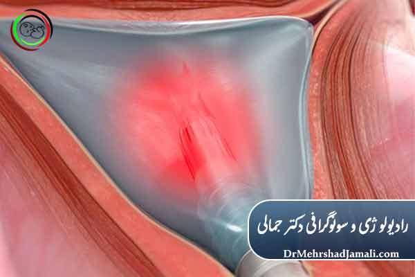 تخلیه اندومتریوز چیست؟