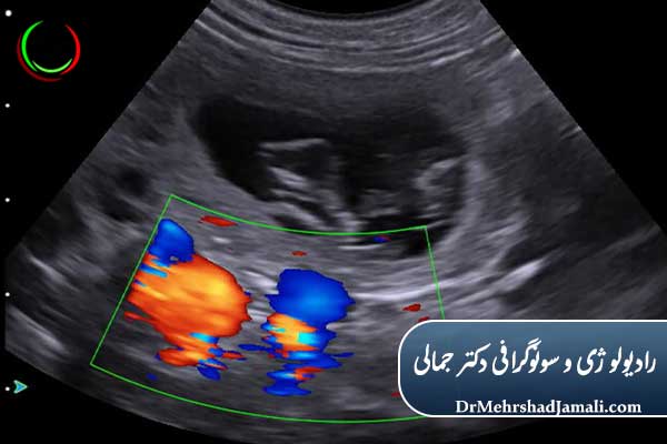 سونوگرافی داپلر از چه هفتهای انجام میشود؟