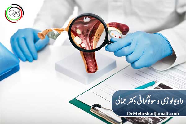 روش‌های درمان فیبروم رحم و پولیپ رحم