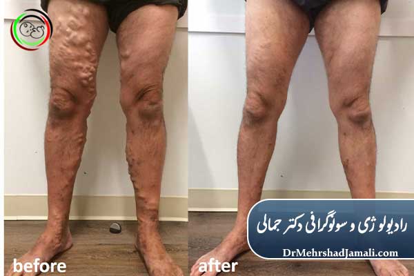 مزایای لیزر واریس نسبت به روشهای سنتی