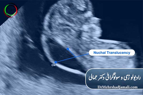 سونوگرافی NT چیست؟