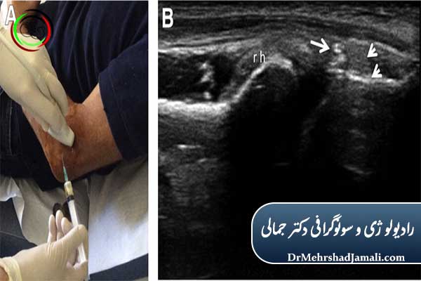 مزایای تزریق PRP با هدایت سونوگرافی نسبت به روش‌های دیگر