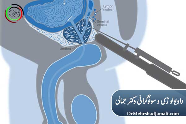 انواع روش‌های نمونه‌برداری پروستات