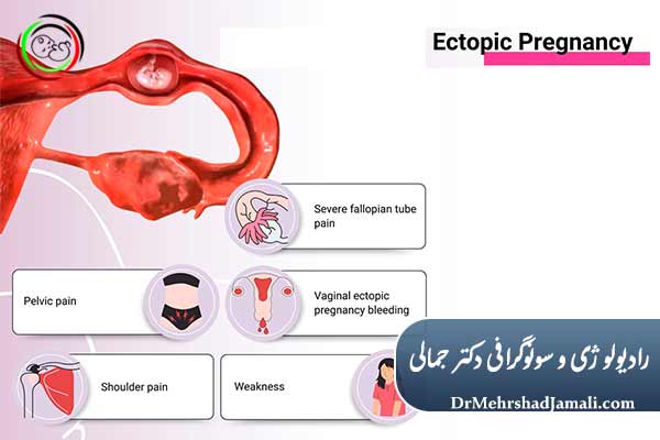  تشخیص قطعی بارداری خارج از رحم توسط سونوگرافی