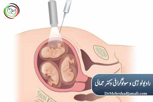 تزریق KCL چیست