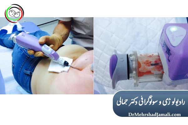 موارد ضروری انتخاب وکیوم بیوپسی برای درمان