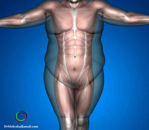 سونوگرافی بعد از جراحی اسلیو معده