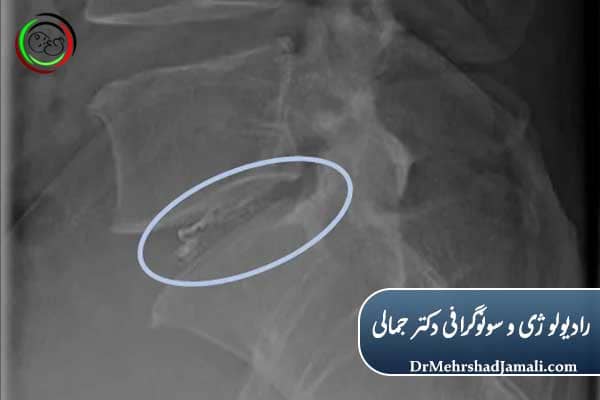 تفاوت تزریق ژل دیسک با جراحی باز