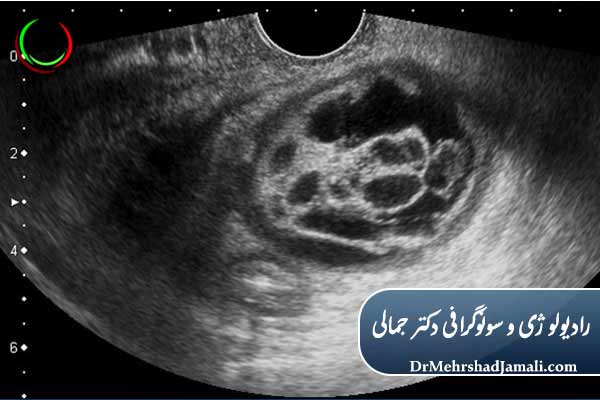 روند انجام تخلیه کیست چگونه است؟