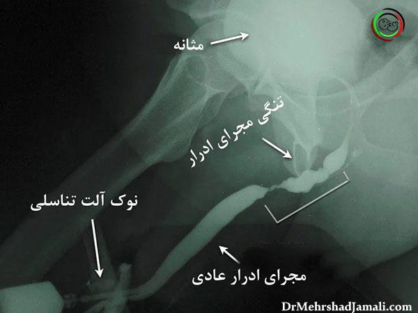 عکس رنگی مجرای ادراری