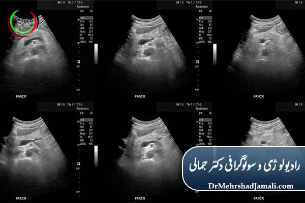 هزینه سونوگرافی شکم چقدر است؟