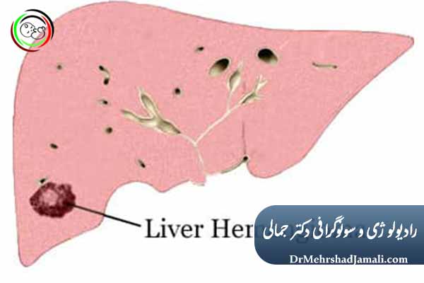 علائم همانژیوم کبدی