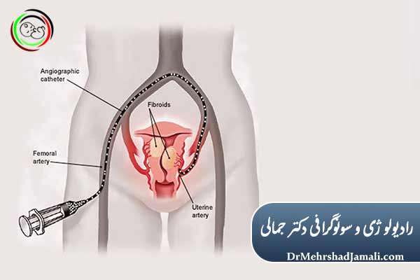 امبولیزاسیون چیست؟