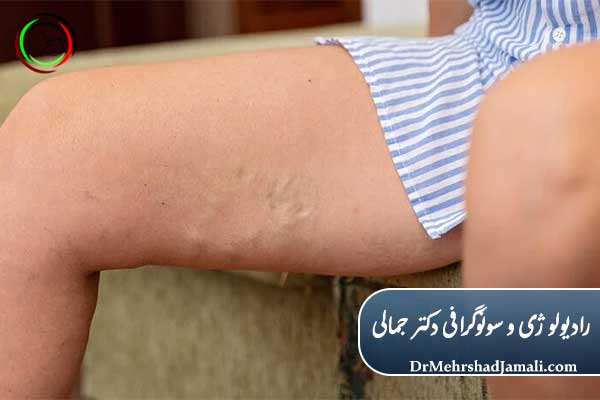 درمان واریس 