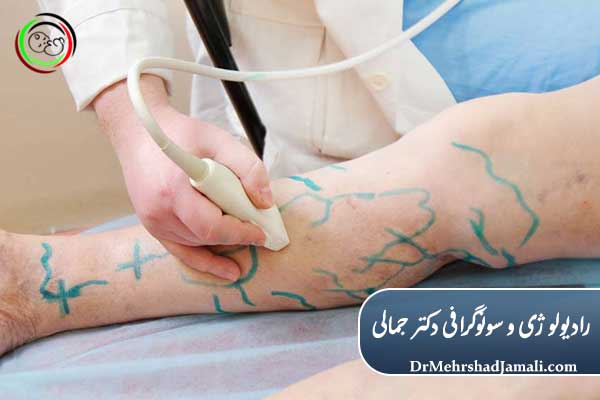 مزایای درمان واریس بدون جراحی