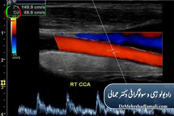 انواع سونوگرافی داپلر