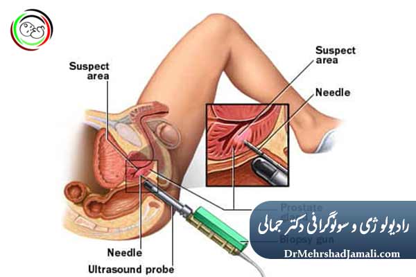سونوگرافی ترانس‌رکتال پروستات