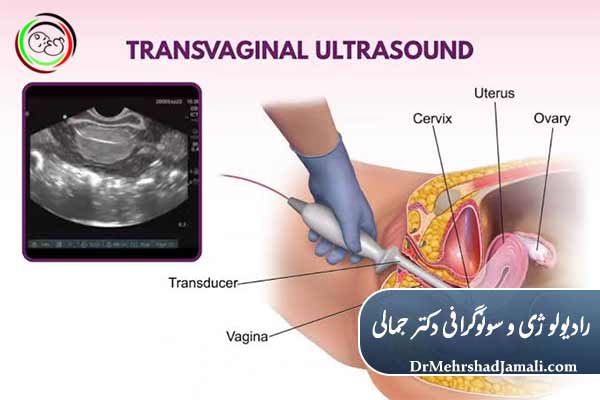  چه زمانی سونوگرافی واژینال بهترین انتخاب است؟