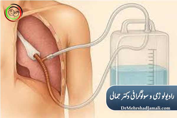 مراحل انجام تخلیه مایع ریه در مرکز ما