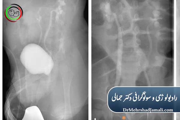 نحوه انجام VCUG (مراحل کامل)