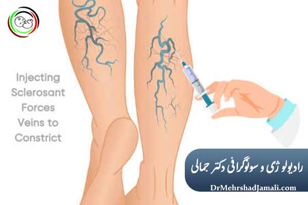 تزریق و اینترونشن واریس