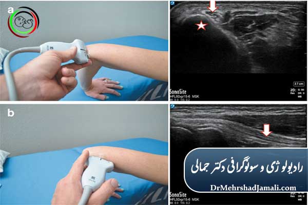 کاربردهای اصلی تزریق PRP (پی آر پی شانه)
