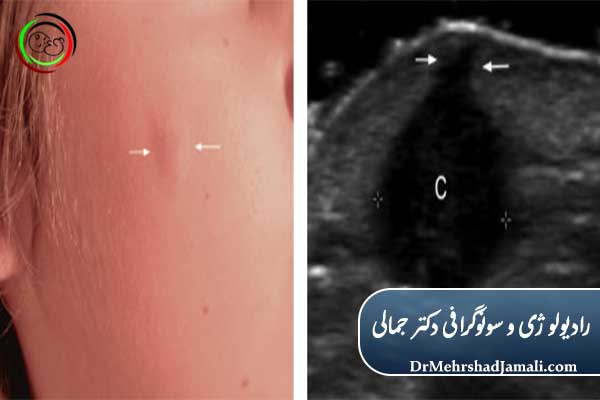 https://drmehrshadjamali.com/post?PId=129/what-is-cyst-symptoms-ultrasound#:~:text=%DA%A9%DB%8C%D8%B3%D8%AA%20(Cyst)%20%DB%8C%DA%A9%20%DA%A9%DB%8C%D8%B3%D9%87%20%DB%8C%D8%A7,%D8%AD%D8%AA%DB%8C%20%D9%86%DA%AF%D8%B1%D8%A7%D9%86%DB%8C%20%D8%A7%D8%B2%20%D8%A8%D8%AF%D8%AE%DB%8C%D9%85%DB%8C%20%D8%B4%D9%88%D9%86%D8%AF.