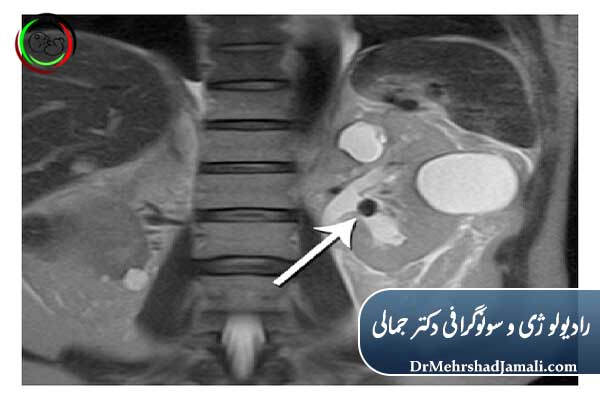 سی‌تی‌اسکن (CT Scan) بدون کنتراست کلیه ها