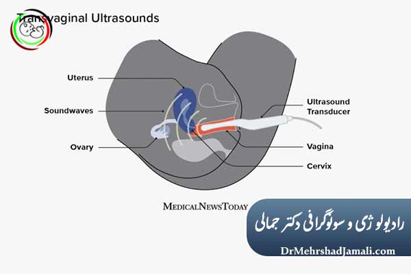 سونوگرافی واژینال خطرناک است ؟