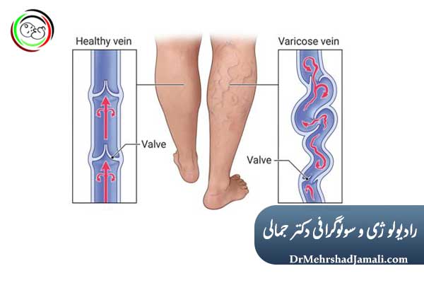 هزینه درمان واریس با روشهای غیرجراحی
