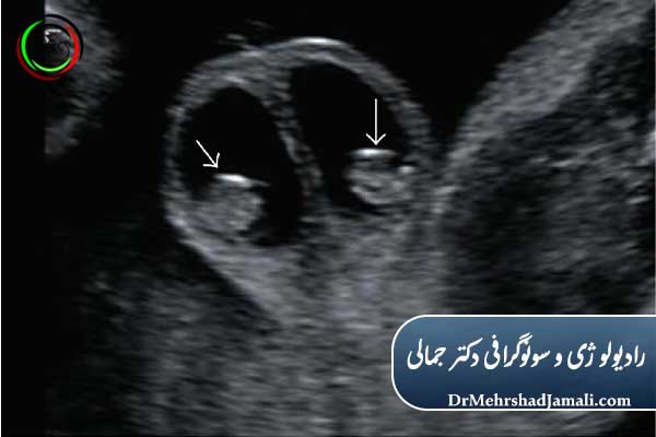 سونوگرافی بیضه