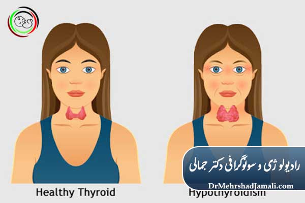 درمان کم‌کاری تیروئید