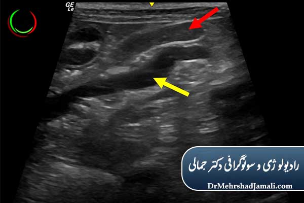 دقت سونوگرافی در تشخیص سرطان غدد لنفاوی