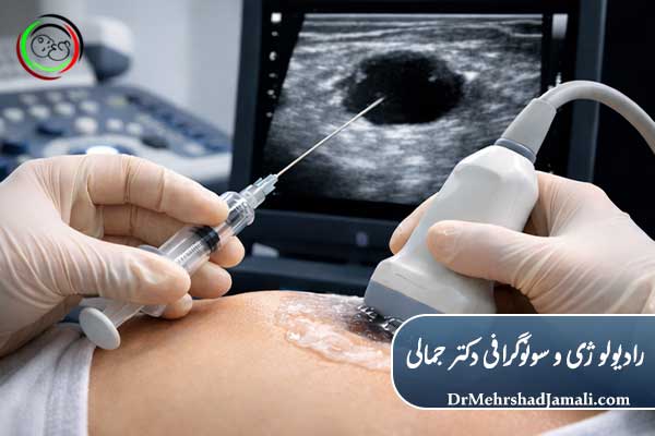 آسپیراسیون کیست چگونه انجام می‌شود؟