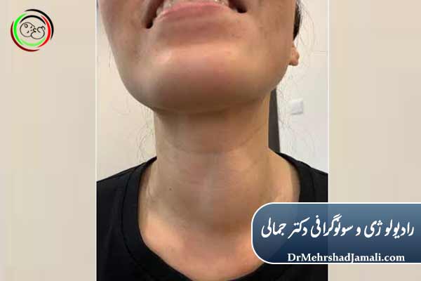 علائم کیست تیروئید چیست