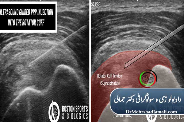 PRP تحت گاید سونوگرافی دقیق‌تر و مؤثرتر
