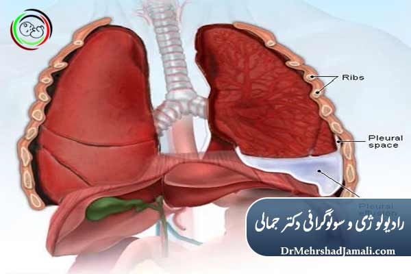 مایع دور ریه (افیوژن پلور